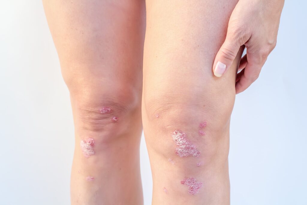 person's knees with psoriasis
