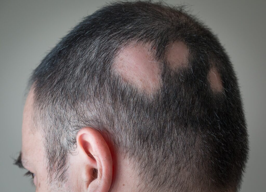 Man with alopecia