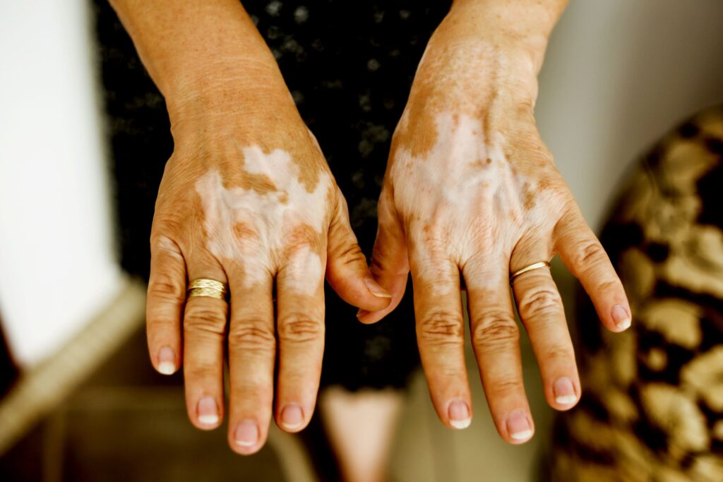 Hands with vitiligo on them