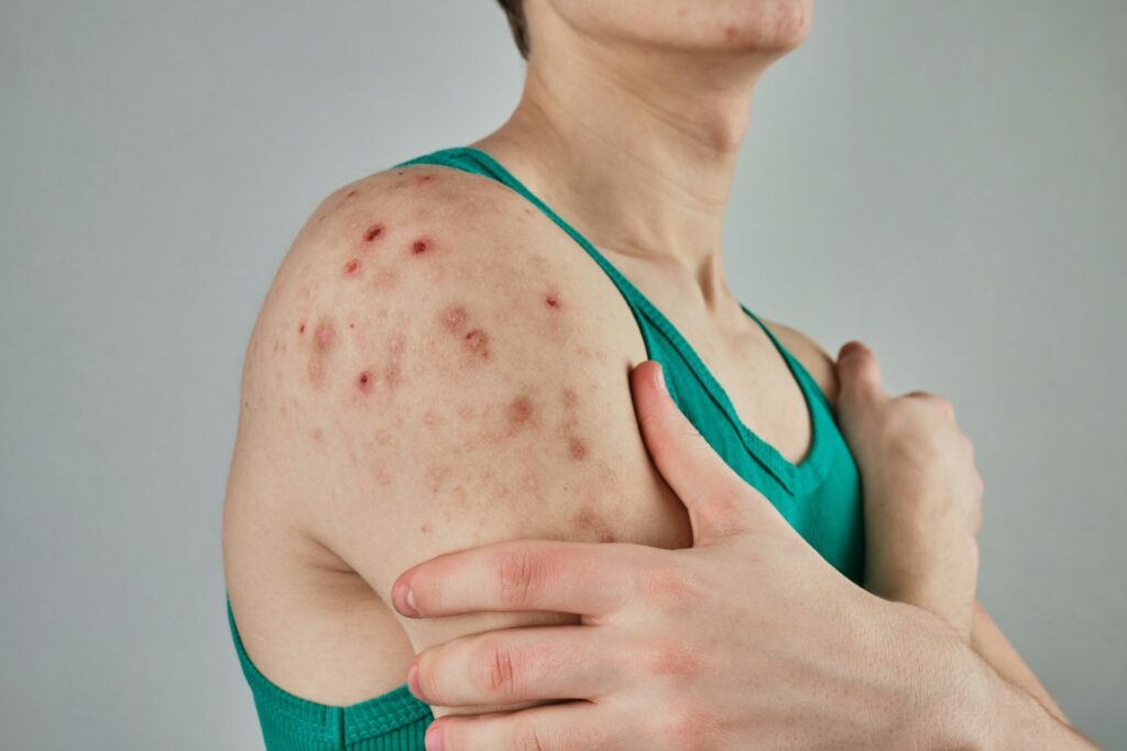 common skin rashes in Phoenix