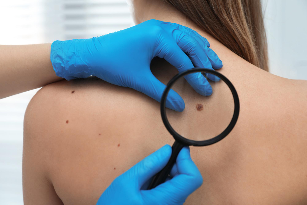Preventing Melanoma