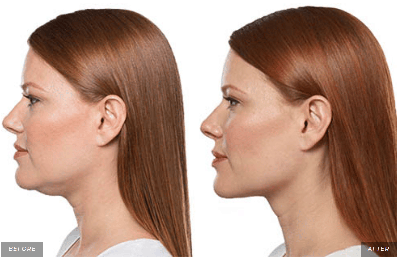 Before and After Kybella